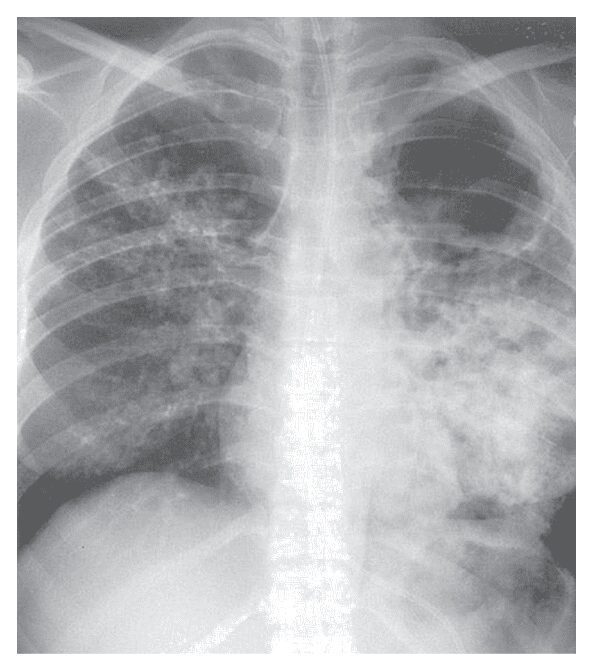 Case lâm sàng 50] Lao phổi › Y khoa, ykhoa.org, Thông tin cập nhật ...