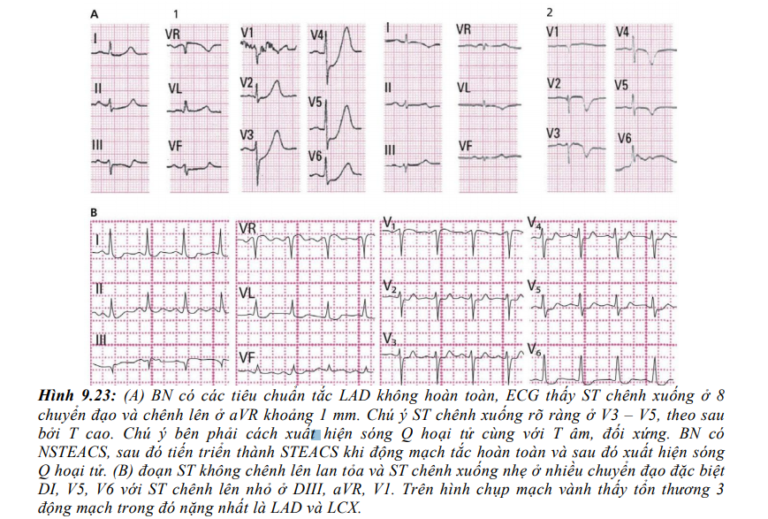[ECG Số 9] Nhồi máu và thiếu máu cục bộ cơ tim › Y khoa
