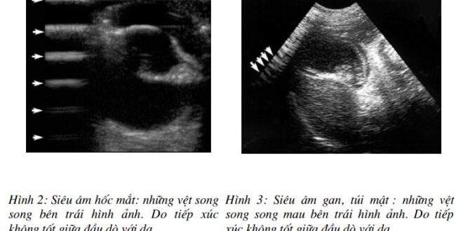 [Siêu âm số 2] Các hình nhiễu ảnh trên siêu âm