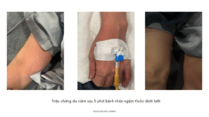 trieu chung da niem sau adr