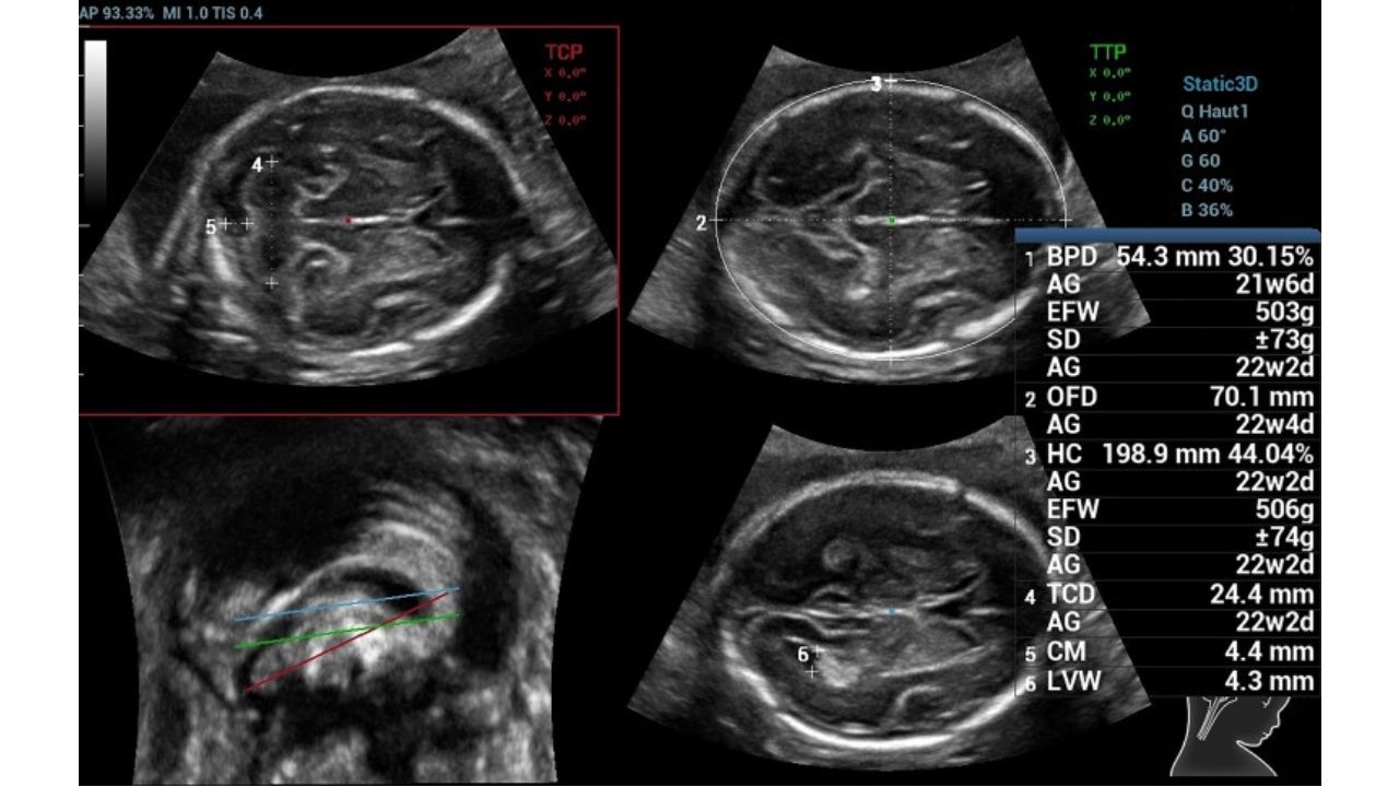chi so bdp trong sieu am thai 2