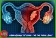Viêm nội mạc tử cung – “kẻ thù thầm lặng” đối với phái đẹp Anh bia mau.zip 2