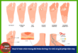 Hoại tử bàn chân trong đái tháo đường: Cơ chế và giải pháp hiện nay Picture2