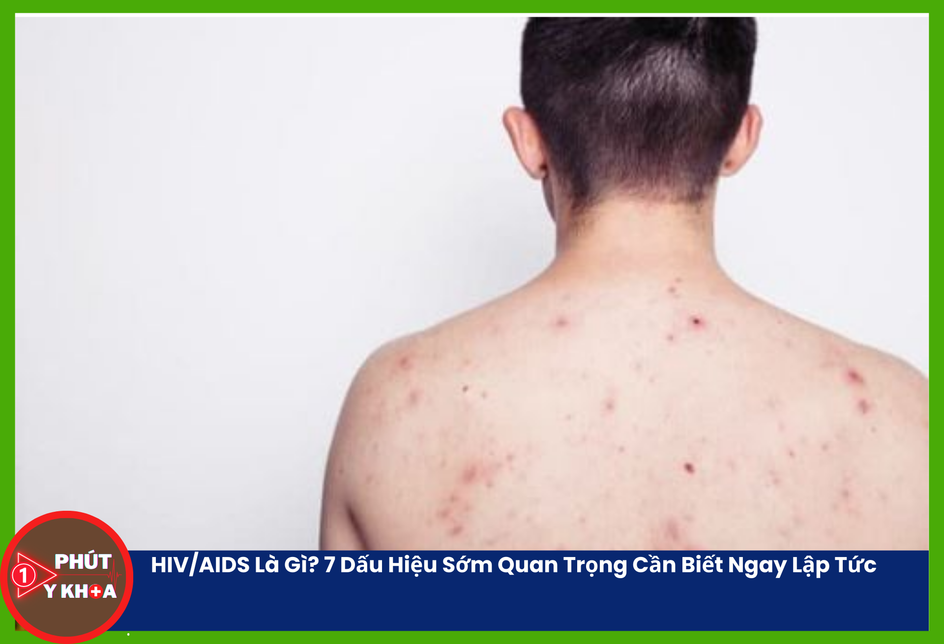 Phát ban HIV thường là ban đỏ dạng dát sẩn (maculopapular rash) – các nốt đỏ nhỏ, phẳng hoặc gồ nhẹ