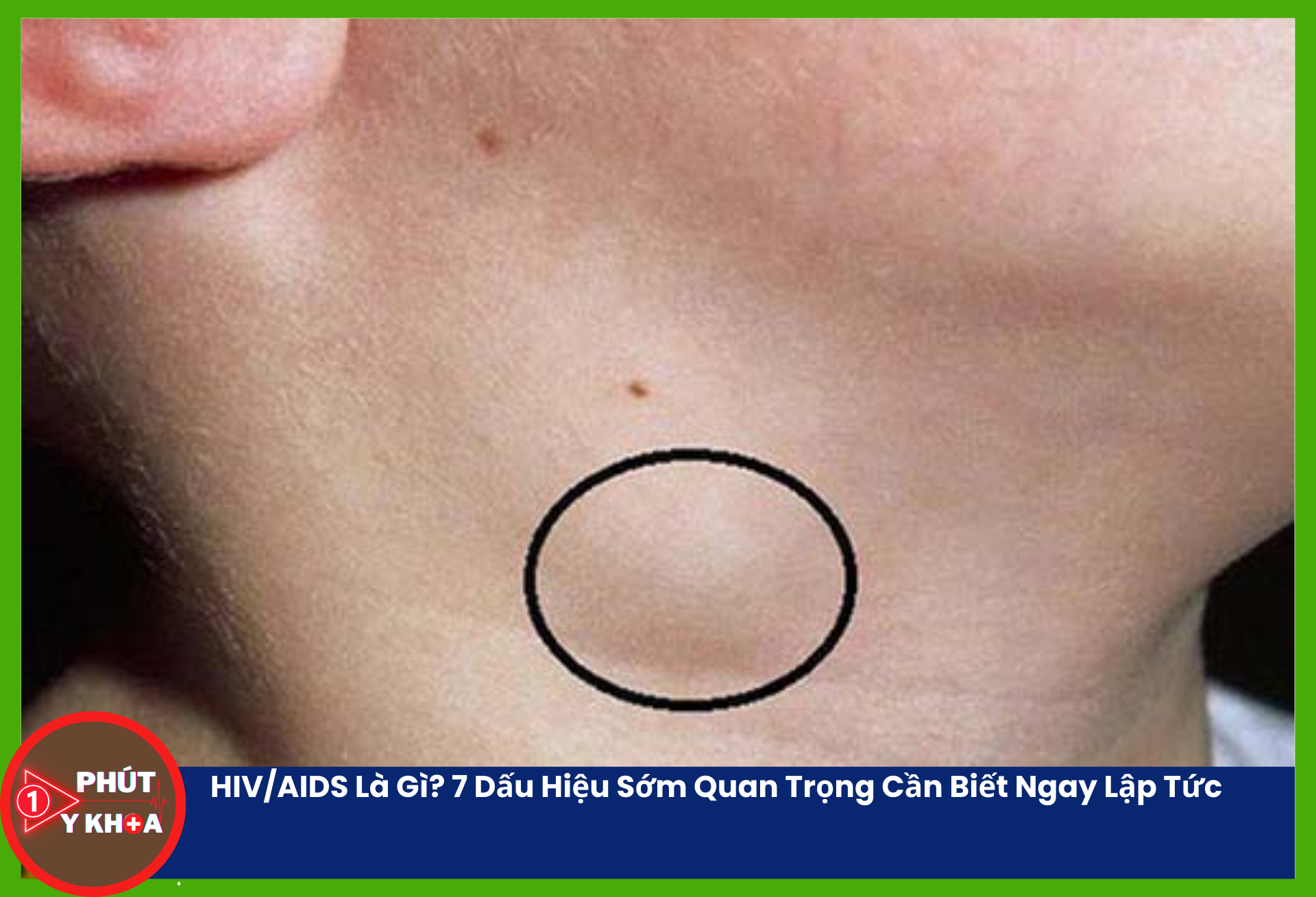 Sưng hạch bạch huyết là triệu chứng được ghi nhận rộng rãi ở những bệnh nhân HIV/AIDS