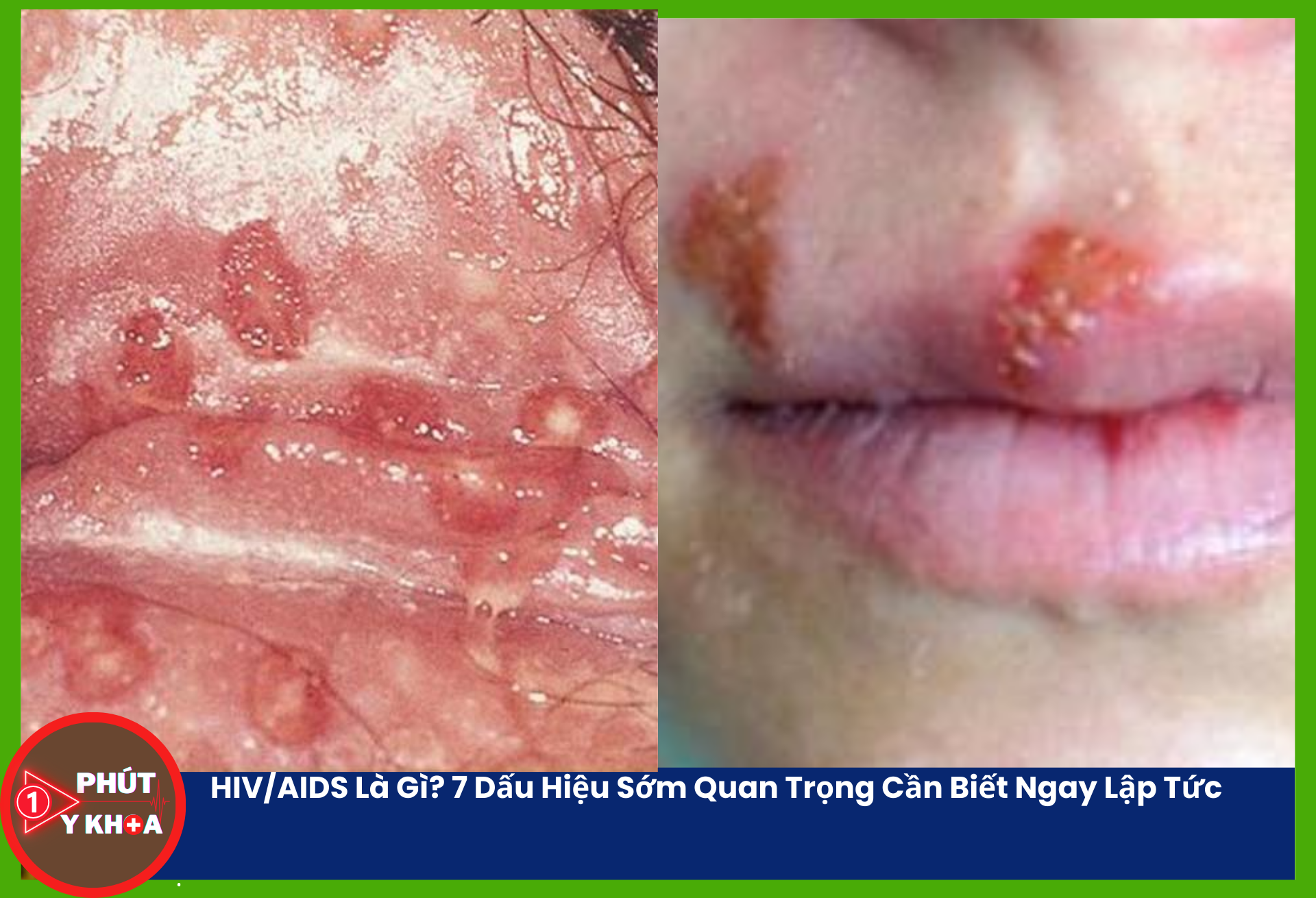 Viêm loét là kết quả của sự phá hủy tế bào niêm mạc do vi-rút và sự tập trung của các tế bào miễn dịch tại vị trí tổn thương.