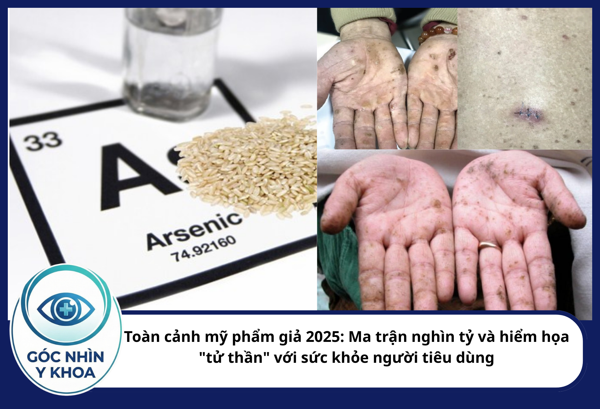 Arsen trong mỹ phẩm kém chất lượng là tác nhân hàng đầu gây ung thư biểu mô tế bào vảy và tế bào đáy trên da