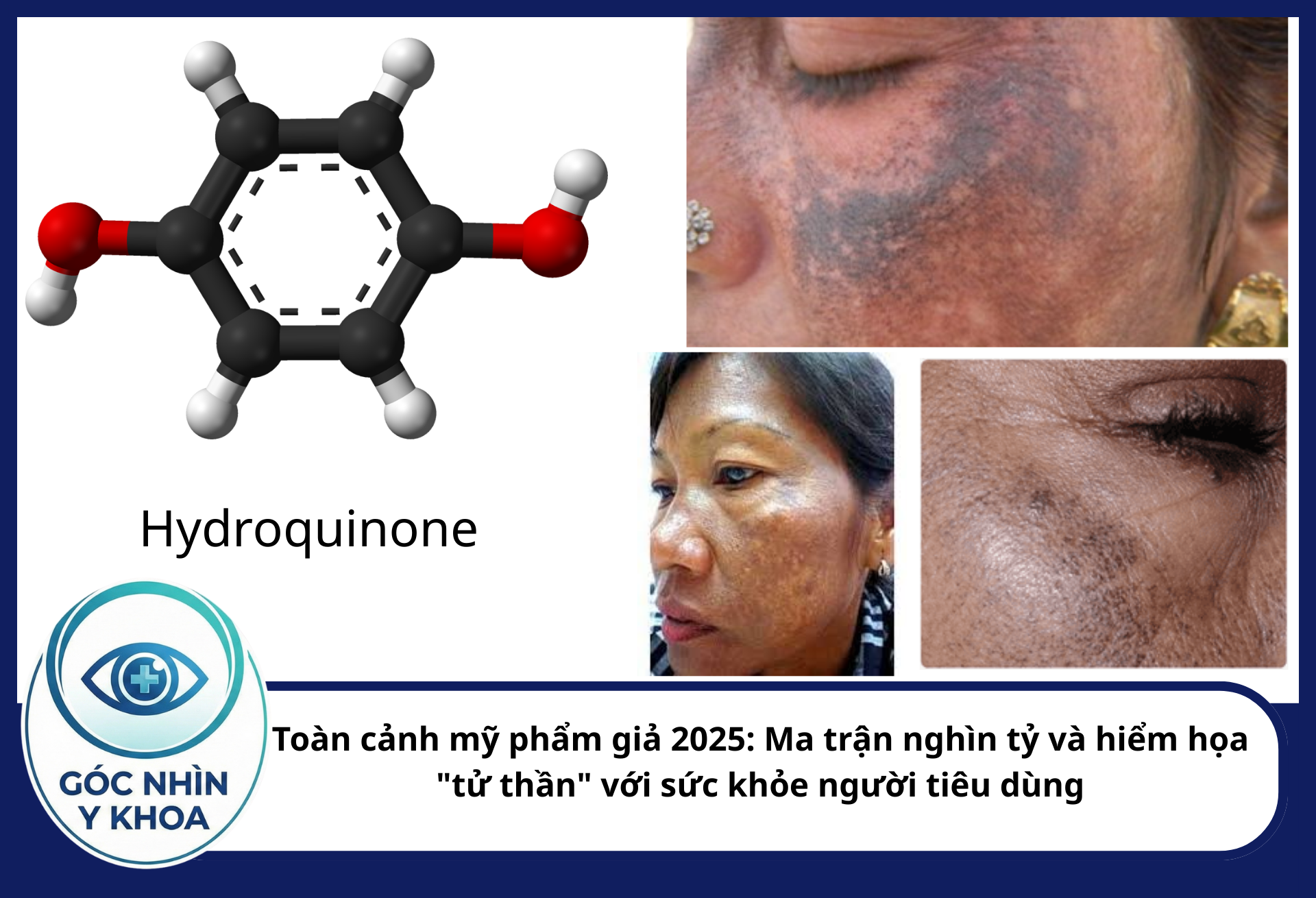 Hydroquinone là hoạt chất kê đơn được kiểm soát chặt chẽ (thường dưới 2%). Tuy nhiên, mỹ phẩm giả thường đẩy nồng độ này lên tới 10-20% để ép da trắng nhanh, gây ra tình trạng nám da do hóa chất