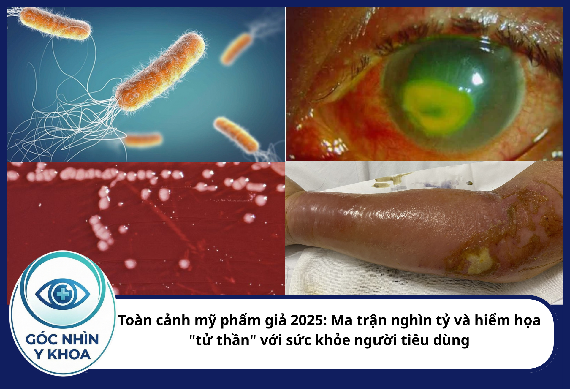 Trực khuẩn mủ xanh có thể gây viêm loét giác mạc, thậm chí mù lòa khi vô tình tiếp xúc với mắt. Không chỉ vậy, nó có thể đi qua những vết xước mụn, gây nhiễm trùng huyết.