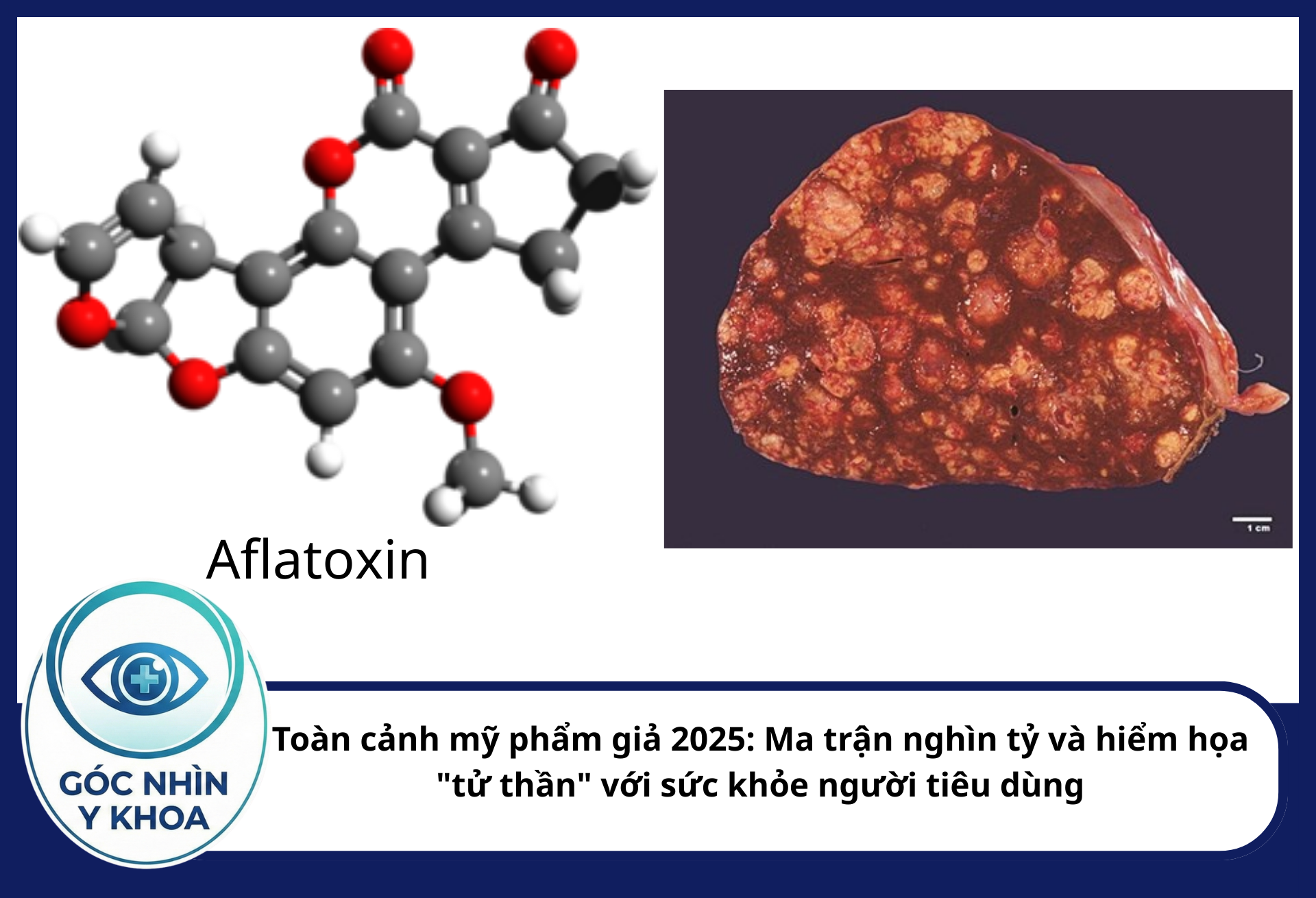 Các loại kem trộn không rõ xuất xứ thường có những hợp chất bị mốc, là môi trường cho Aspergillus sản sinh độc tố Aflatoxin - là chất cực độc gây ung thư gan.