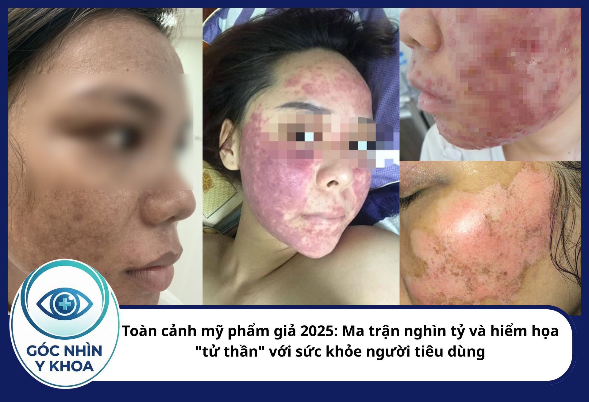 Sử dụng mỹ phẩm giả về lâu dài có thể tác động tiêu cực lên da, mặt của người tiêu dùng. Gây hủy hoại nhan sắc, gián tiếp dẫn đến một số bệnh về tâm lí.