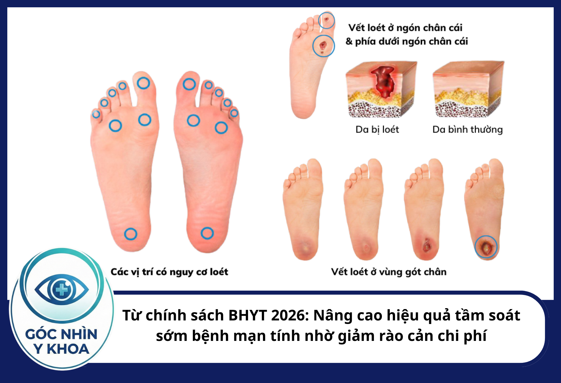 Từ chính sách BHYT 2026: Nâng cao hiệu quả tầm soát sớm bệnh mạn tính nhờ giảm rào cản chi phí Khi chi phí khám chuyên khoa được BHYT đảm bảo 100%, bệnh nhân ĐTĐ sẽ được tầm soát biến chứng sớm, giảm tỷ lệ đoạn chi và tàn tật.