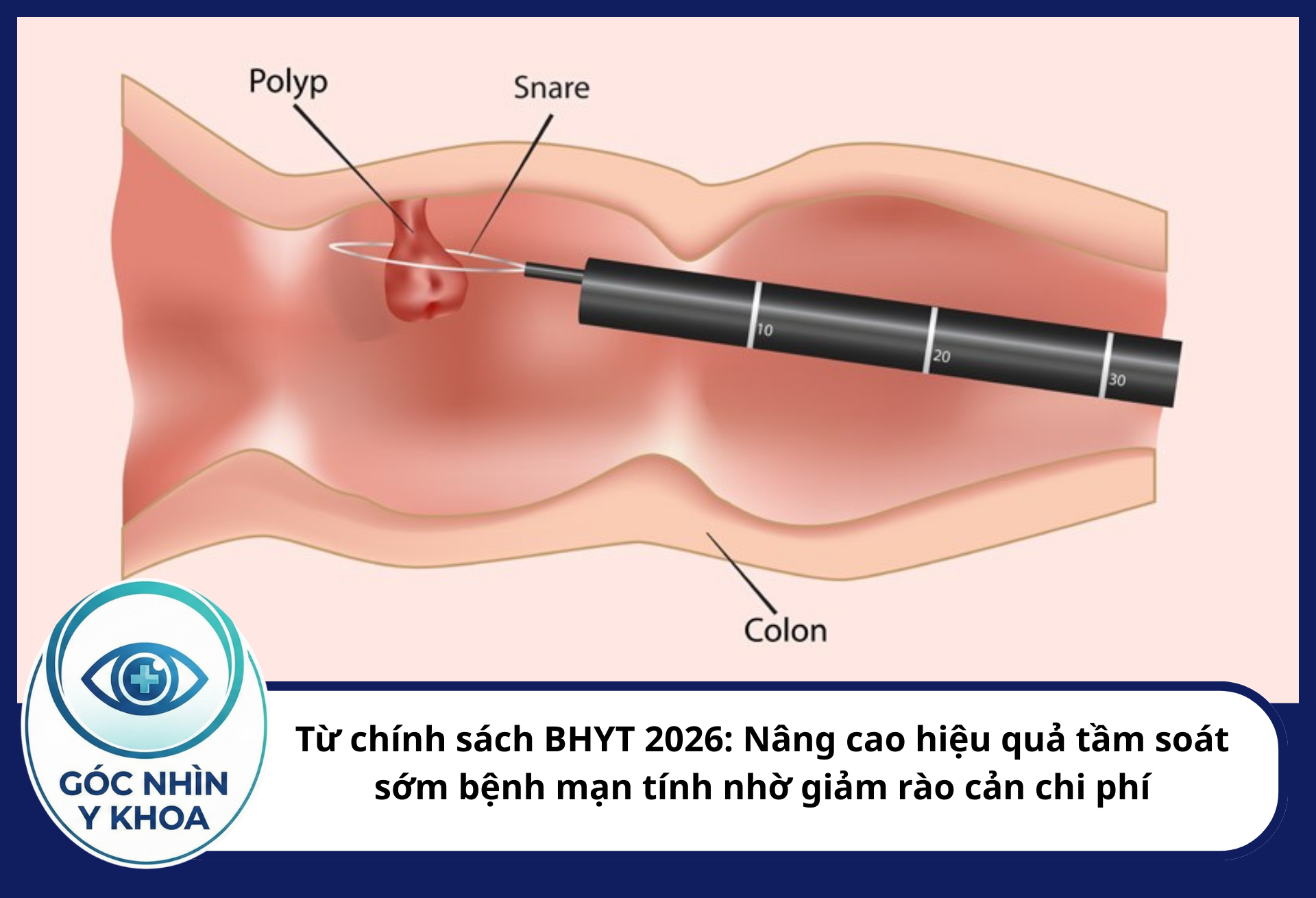 Từ chính sách BHYT 2026: Nâng cao hiệu quả tầm soát sớm bệnh mạn tính nhờ giảm rào cản chi phí Việc chi trả BHYT cho nội soi đại tràng tầm soát giúp phát hiện và cắt bỏ polyp ngay trong lúc khám,nhờ đó tỷ lệ ung thư đại trực tràng trong cộng đồng có thể giảm đáng kể