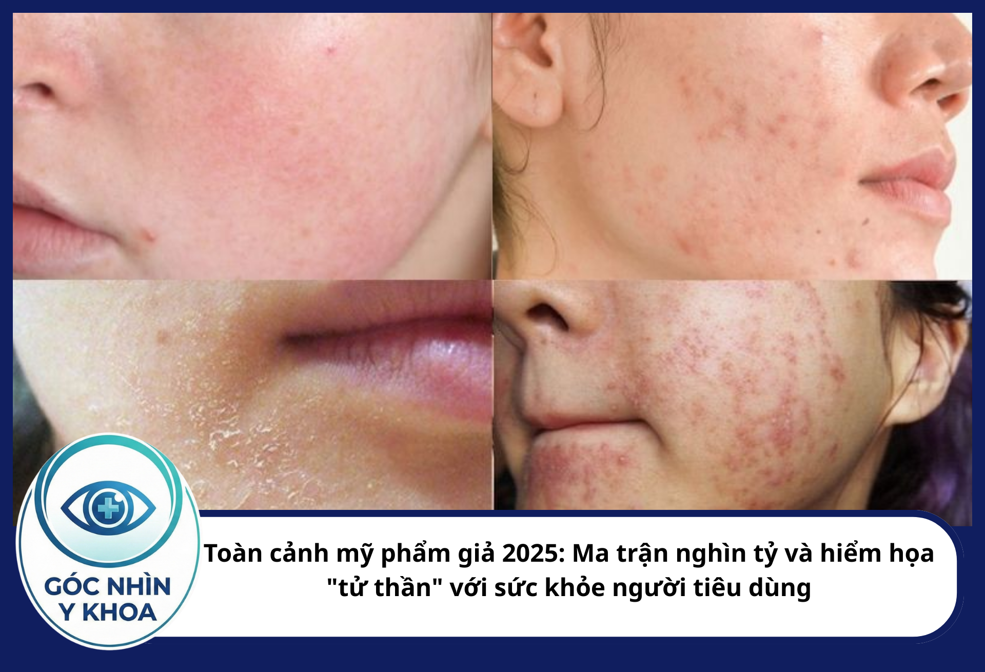 Corticoid ức chế sự tổng hợp Collagen và Elastin, làm biểu bì mỏng dần, lộ rõ các lưới mao mạch
