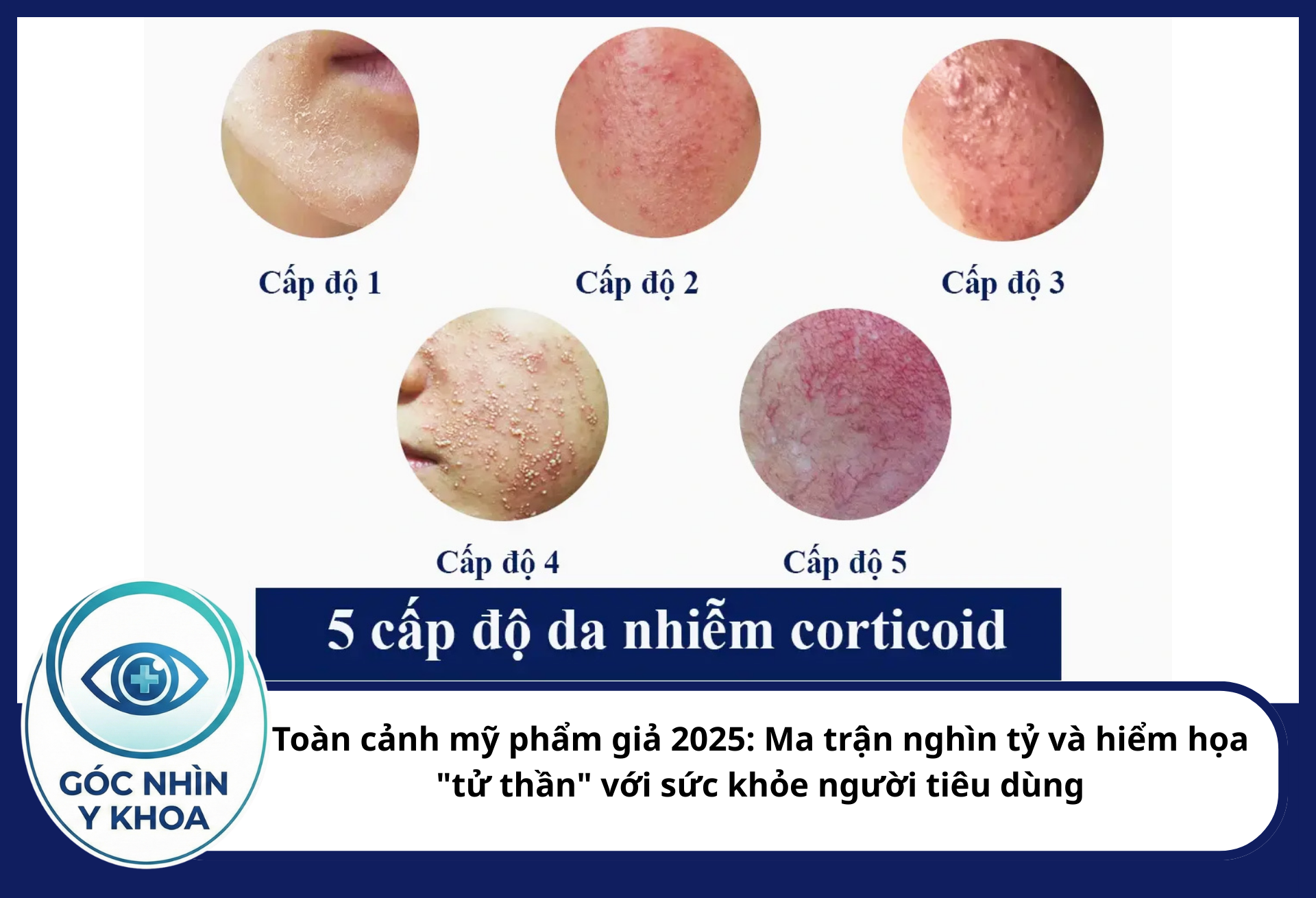 Khi ngưng sử dụng, bệnh nhân rơi vào trạng thái "da bùng phát" với các biểu hiện đỏ rực, sưng nề, rỉ dịch và cảm giác bỏng rát như bị hỏa hoạn trên mặt