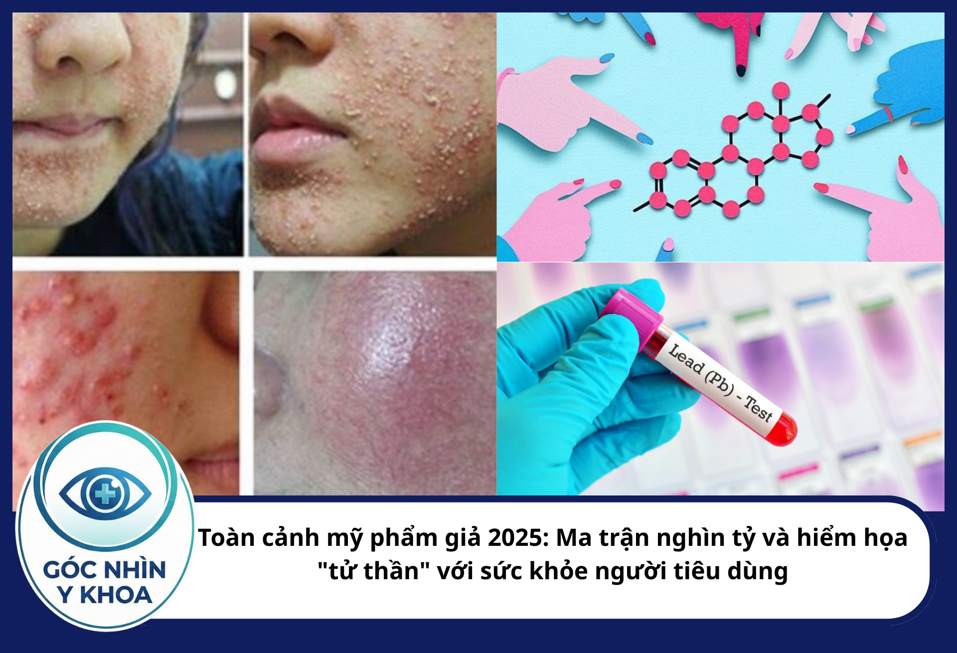 Chì tích tụ trong xương và máu, thay thế Canxi trong các phản ứng sinh hóa, gây thiếu máu, tổn thương gan và cực độc đối với phụ nữ thai kì, gây dị tật bẩm sinh cho thai nhi.