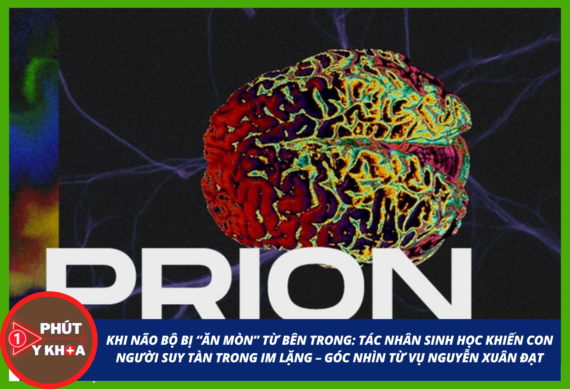 prion nxd 2