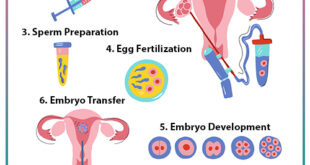 Common Questions About IVF
