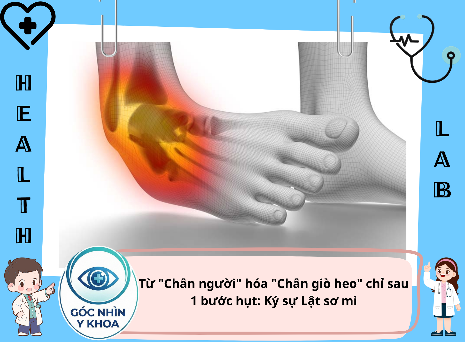 Đa số các ca lật sơ mi (khoảng 85%) là lật má ngoài (Inversion injury), tức là bàn chân quặp vào trong, làm giãn dây chằng bên ngoài (Nhìn đau vờ lờ thề...)