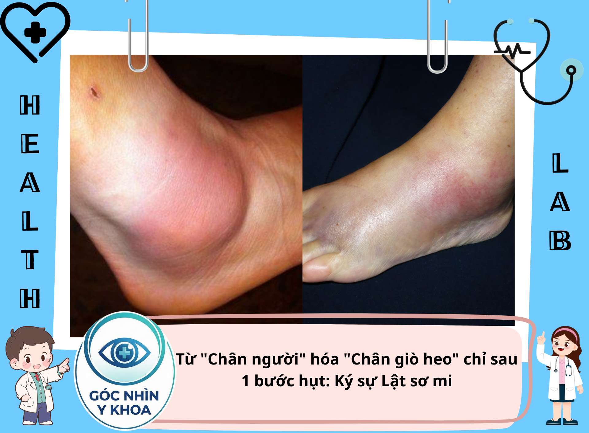 Đây là "tác phẩm" tiếp theo của lật sơ mi sau khi dịch viêm xuất hiện. (Trông sưng to ngang quả bưởi=))). Nói chung là đau.)