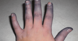 da tim tai la bieu hien va trieu chung cua benh gi1 1227