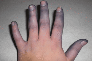 da tim tai la bieu hien va trieu chung cua benh gi1 1227