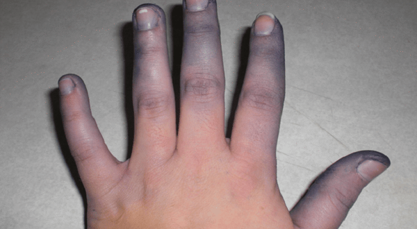 da tim tai la bieu hien va trieu chung cua benh gi1 1227