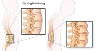 dieu tri viem cot song dinh khop hinh dai dien