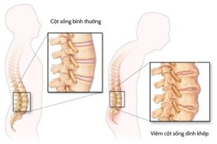 dieu tri viem cot song dinh khop hinh dai dien