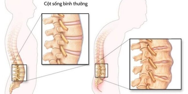 dieu tri viem cot song dinh khop hinh dai dien
