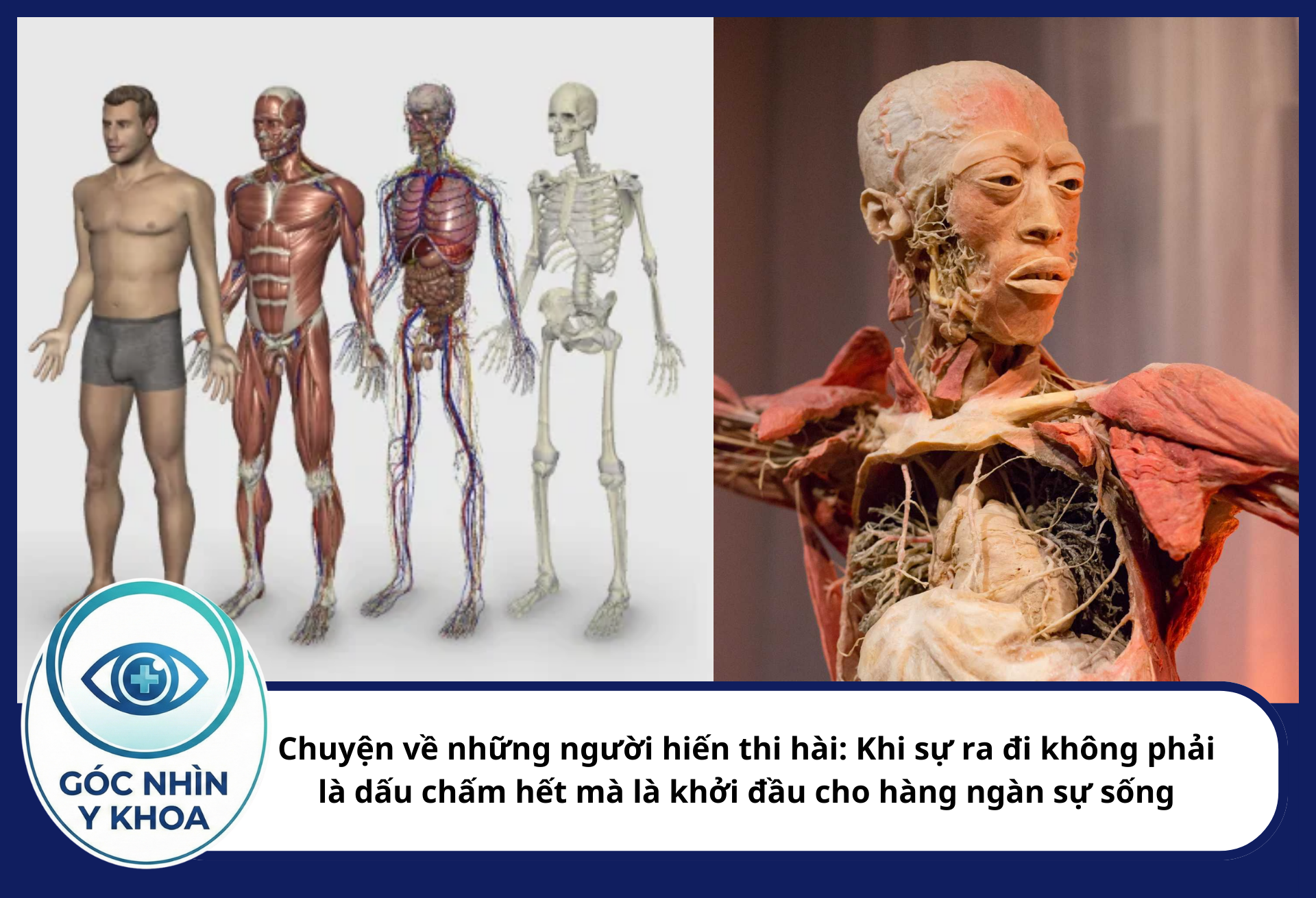 Chuyện về những người hiến thi hài: Khi sự ra đi không phải là dấu chấm hết mà là khởi đầu cho hàng ngàn sự sống Goc nhin Y khoa 77