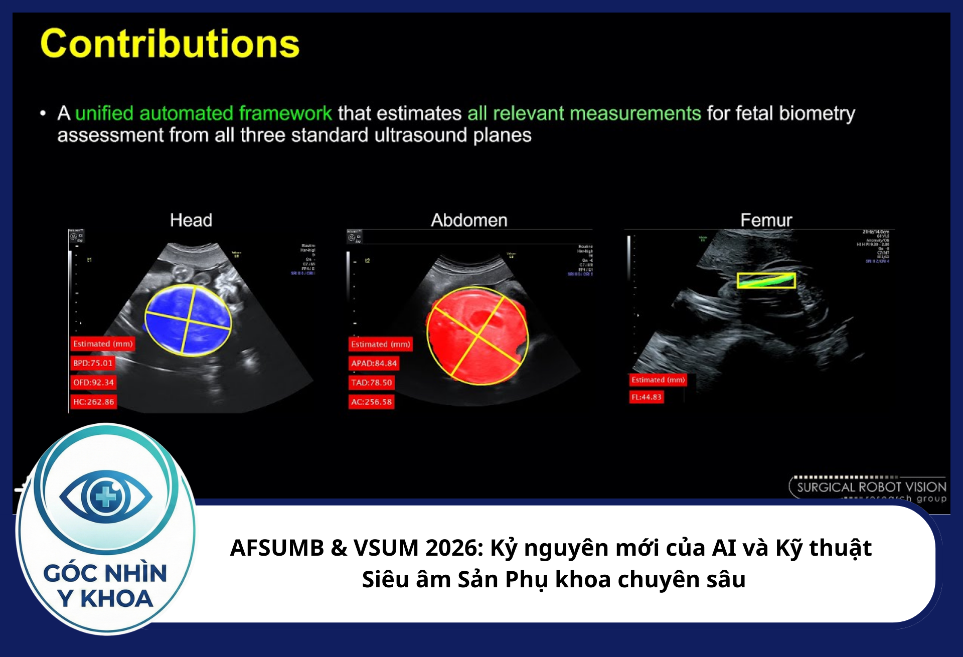 Các báo cáo mới nhất dự kiến trình bày tại hội nghị sẽ giới thiệu các thuật toán AI có khả năng tự động nhận diện mặt phẳng cắt chuẩn và thực hiện đo đạc các chỉ số sinh học thai nhi (như đường kính lưỡng đỉnh, chu vi vòng đầu, xương đùi) chỉ với một cú click chuột