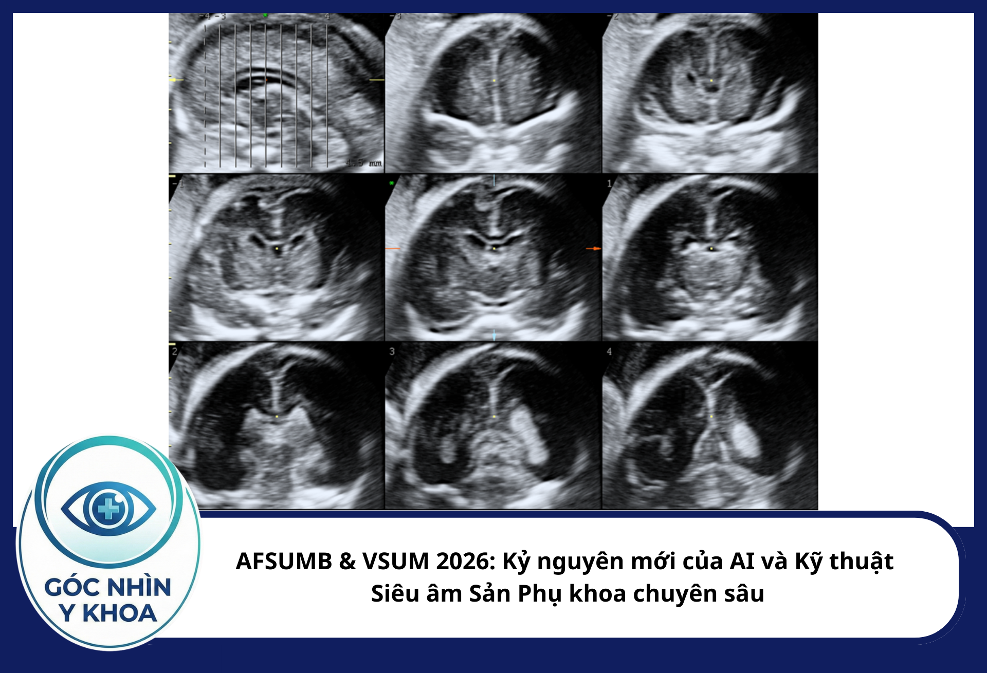  Kỹ thuật siêu âm hệ thần kinh chuyên sâu (Neurosonogram) không còn chỉ dành cho các ca nghi ngờ, mà đang dần được khuyến cáo tích hợp vào các mốc sàng lọc quan trọng để phát hiện sớm các bất thường di trú tế bào thần kinh hoặc bất thường thể chai.