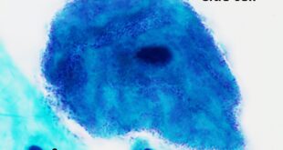 Micrograph of a clue cell annotated