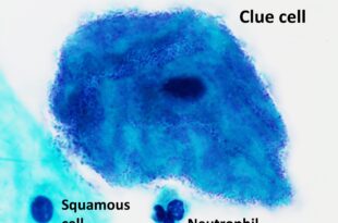 Micrograph of a clue cell annotated
