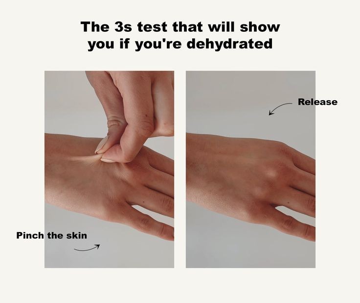 Dấu véo da (Casper +) :Đánh giá tình trạng mất nước ban đầu. dau veo da