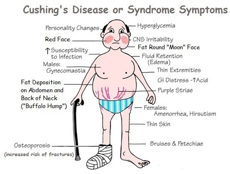 Toàn cảnh về Cortisol – Mảnh ghép trung tâm của hệ nội tiết và miễn dịch. Hình minh họa các đặc điểm lâm sàng điển hình của hội chứng Cushing do tăng hoocmon Cortisol mạn tính.