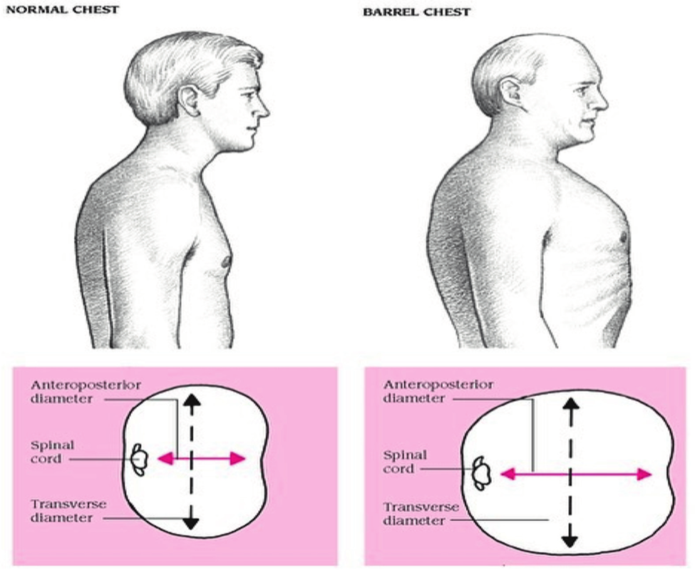 Lồng ngực hình thùng ở bệnh nhân COPD: Một dấu hiệu ngày càng hiếm gặp Hình minh họa sự khác biệt giữa lồng ngực bình thường và lồng ngực hình thùng.
Nguồn: Bickley LS. Bates’ Guide to Physical Examination and History Taking, Wolters Kluwer; Radiopaedia.org (Barrel chest illustration).