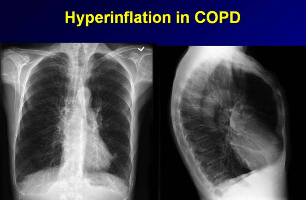 Lồng ngực hình thùng ở bệnh nhân COPD: Một dấu hiệu ngày càng hiếm gặp Hình X-quang cho thấy phổi bị tăng thông khí trong COPD với cơ hoành dẹt, phế trường tăng sáng và lồng ngực giãn rộng. Tình trạng phổi luôn căng phồng do bẫy khí làm tăng đường kính trước – sau của lồng ngực, từ đó góp phần tạo nên hình dạng lồng ngực hình thùng trên lâm sàng.
Nguồn: Radiopaedia.org – COPD with marked lung hyperinflation, case courtesy of Dr. Frank Gaillard.