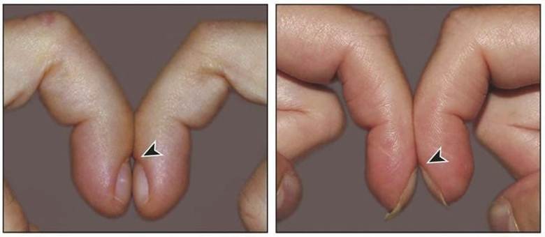 Bàn tay dùi trống: dấu hiệu cảnh báo bệnh phổi và tim mạch. image