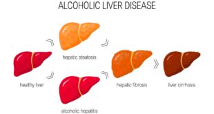 Suy giảm chức năng gan và các bệnh lý thường gặp do ngộ độc rượu