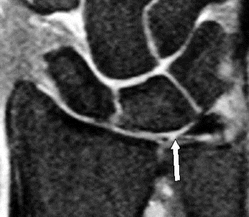 tfcc mri 2