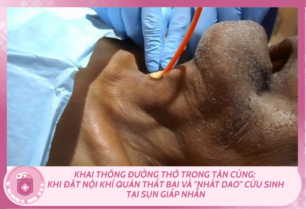 Khai thông đường thở trong tận cùng: khi đặt nội khí quản thất bại và "nhát d.a.o" cứu sinh tại sụn giáp nhẫn