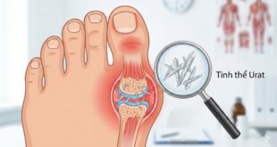 Tinh the Urat 1