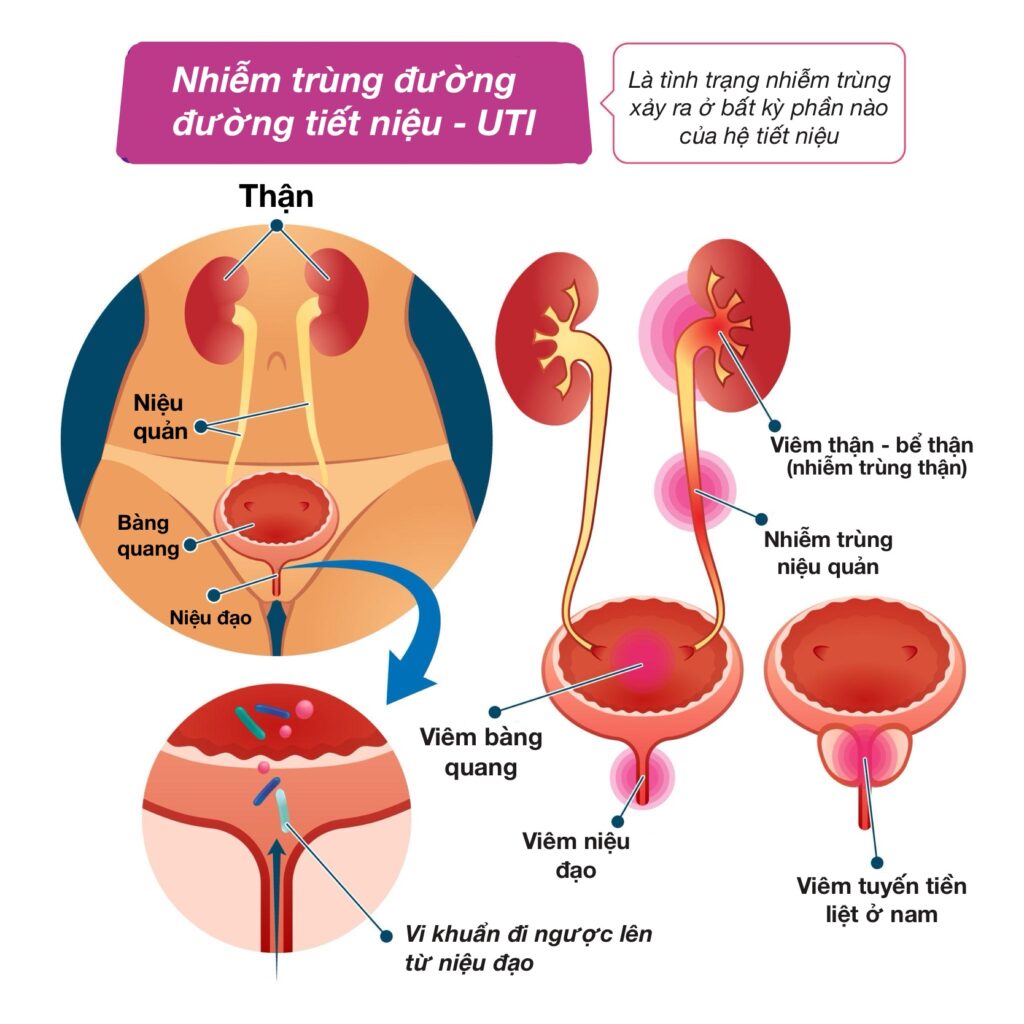 Hình ảnh tổng quan về nhiễm trùng tiểu (UTI)