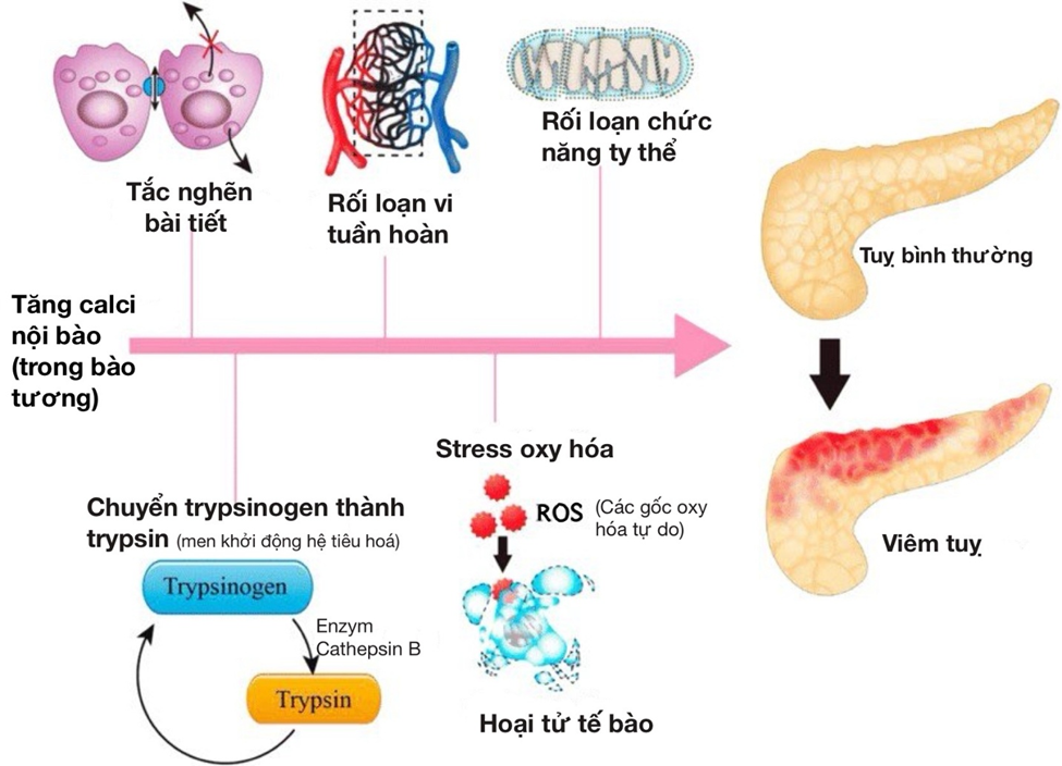 Hình mô tả cơ chế viêm tụy cấp: tăng Ca²⁺ nội bào gây rối loạn vi tuần hoàn và rối loạn chức năng ty thể, làm giảm ATP và tăng stress oxy hóa.