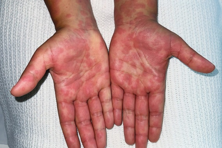 Hình ảnh cho thấy ban đỏ (erythema) ở lòng bàn tay hai bên, biểu hiện bằng các vùng da đỏ hồng lan tỏa, ranh giới không rõ và bề mặt da vẫn phẳng.