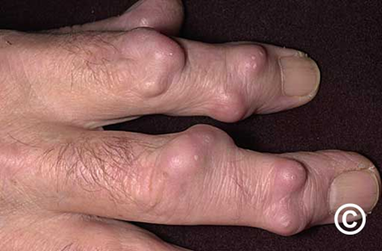 Hình ảnh cho thấy các cục (nodules) ở vùng khớp ngón tay, biểu hiện bằng những khối gồ tròn, kích thước lớn hơn 1 cm, ranh giới rõ và nằm sâu dưới da.
