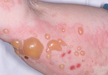 Hình ảnh cho thấy các bóng nước (bulla) và mụn nước trên nền da đỏ, với nhiều tổn thương chứa dịch trong màu vàng nhạt, nổi cao trên bề mặt da.