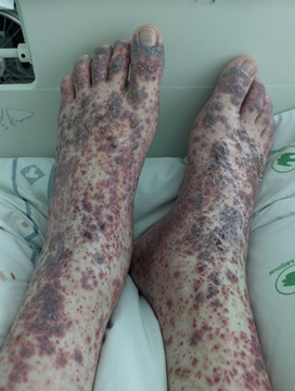 Hình ảnh cho thấy ban xuất huyết (purpura) lan rộng ở hai bàn chân và cẳng chân, biểu hiện bằng nhiều tổn thương màu đỏ tím kích thước vài mm, rải rác và hợp lại thành từng mảng lớn.